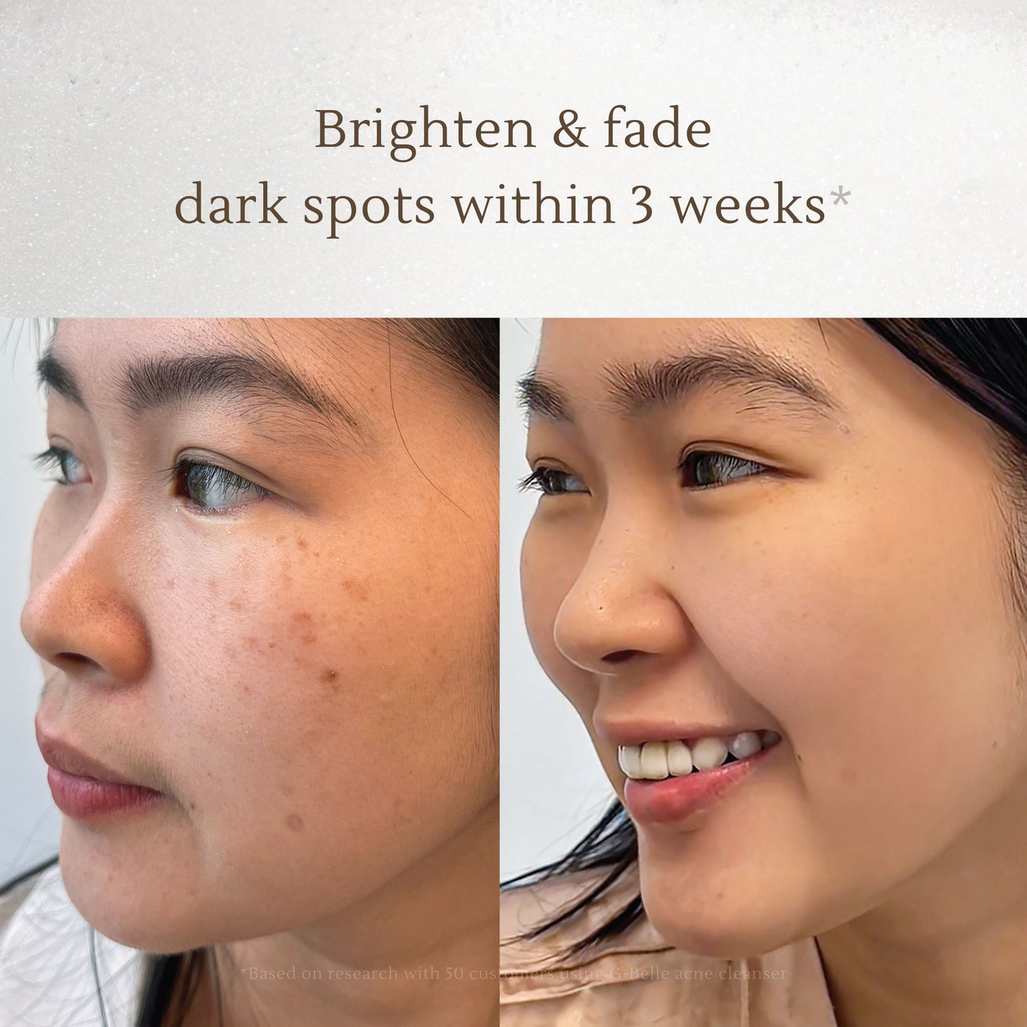 Intensive Dark Spot Care – Fades Acne Scars, Brightens Skin, Corrects Hyperpigmentation – Safe for All Skin Types