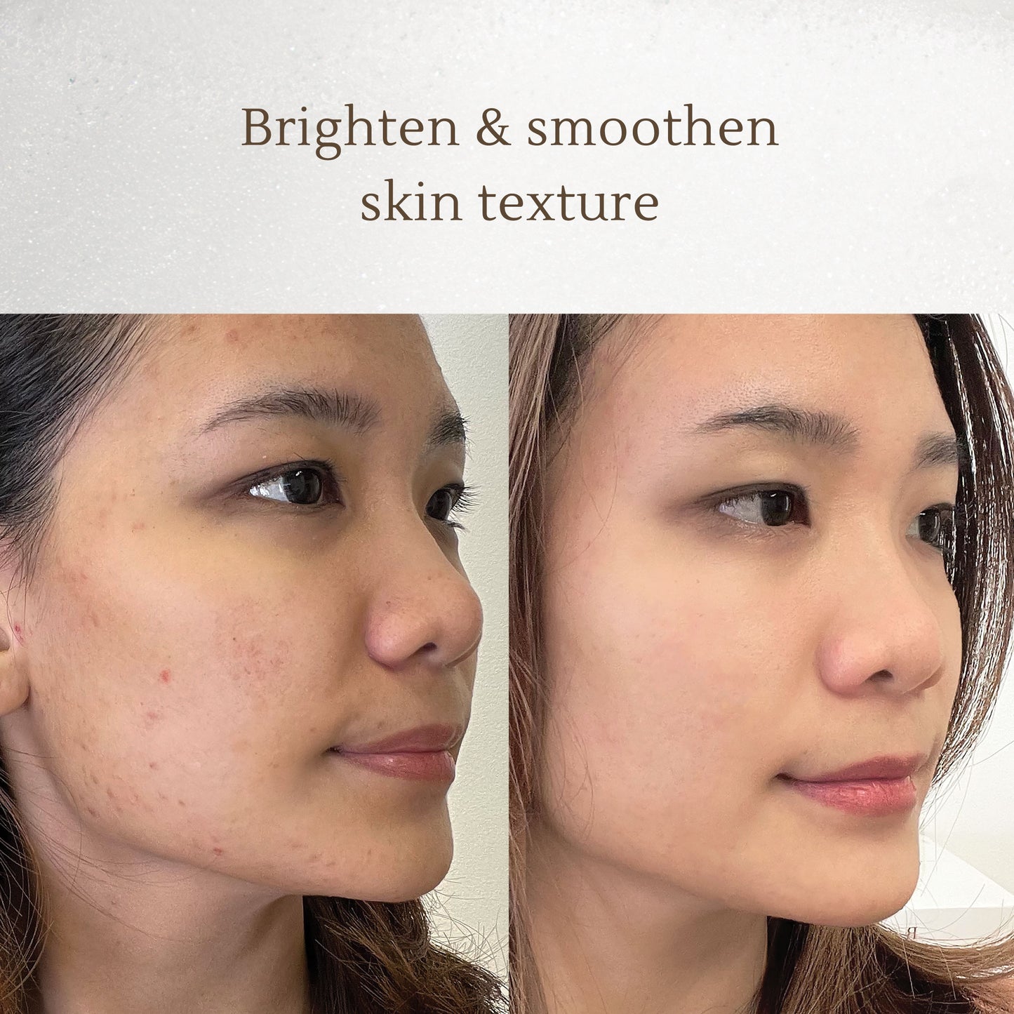 Intensive Dark Spot Care – Fades Acne Scars, Brightens Skin, Corrects Hyperpigmentation – Safe for All Skin Types