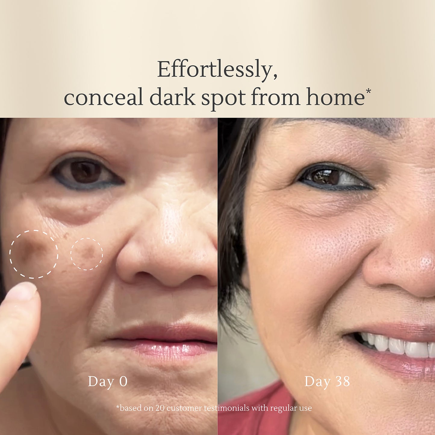 Intensive Dark Spot Care – Fades Acne Scars, Brightens Skin, Corrects Hyperpigmentation – Safe for All Skin Types