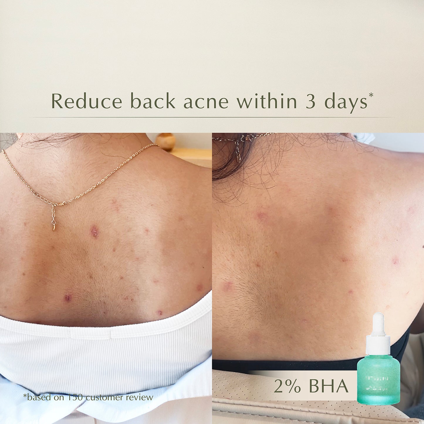 Acne Serum – Prevents Acne & Exfoliates – Cleans Pores & Deflates Acne 10X Faster – 20ml