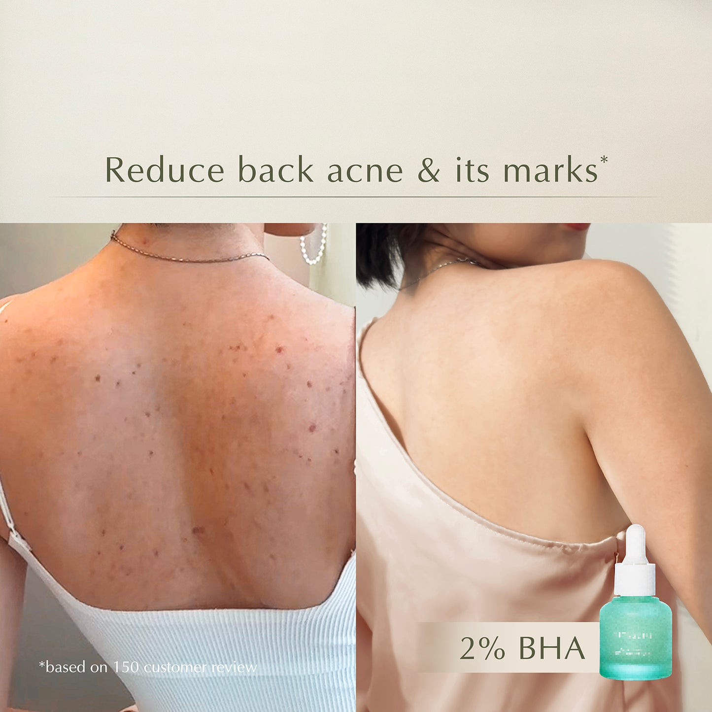 Acne Serum – Prevents Acne & Exfoliates – Cleans Pores & Deflates Acne 10X Faster – 20ml