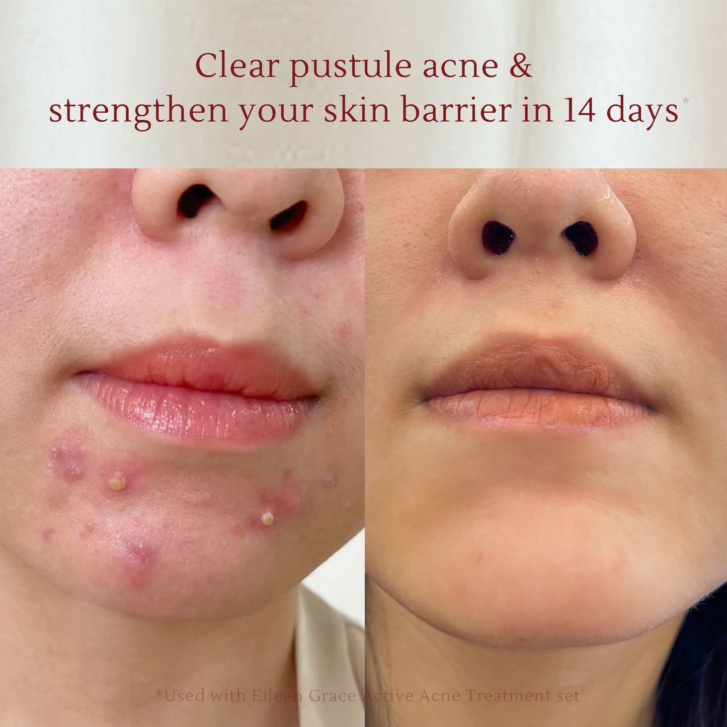 Acne Care Essence – Soothing & Hydrating Gel for Acne-Prone Skin – Prevents Acne, Reduces Redness & Increases Glowing Skin – 30ml