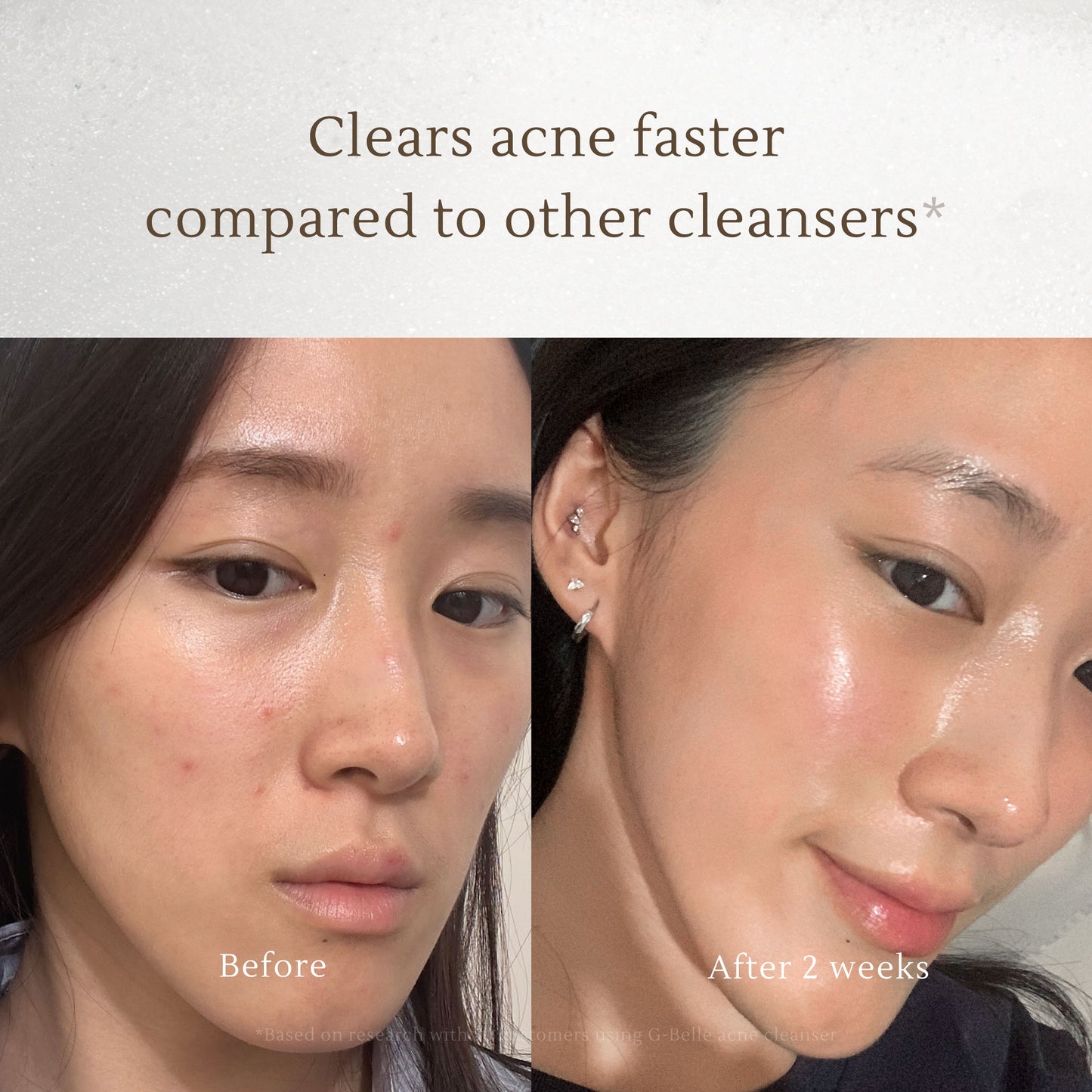 Cleansing Acne Mousse – 3-in-1 Facial Wash with Soft Silicon Brush – Deep Cleans, Exfoliates & Targets Acne – 150ml