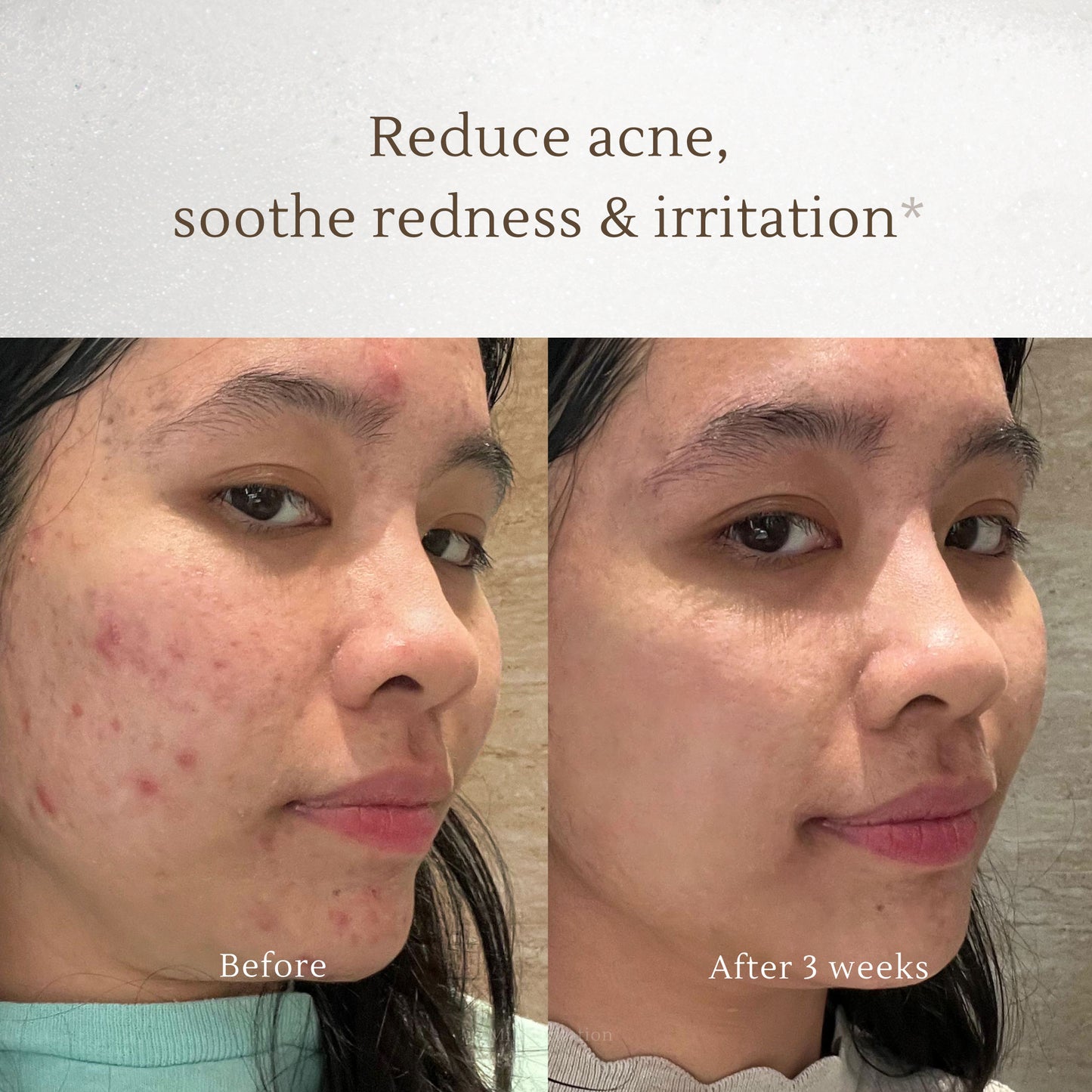 Acne Prevention Set - Fades Acne Scars with Vitamin C, Brightens Dull Skin - Deep Pore Cleansing with Gentle Exfoliation