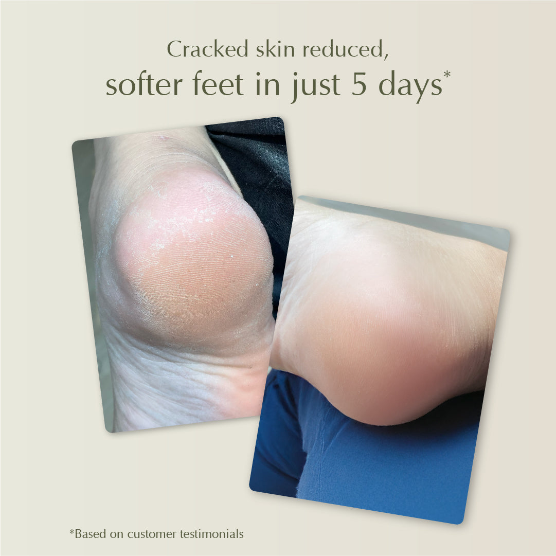 Cooling Foot Spray – Prevent Foot Odor, Reduce Calluses, and Relieve Cracked Heels – 50ml