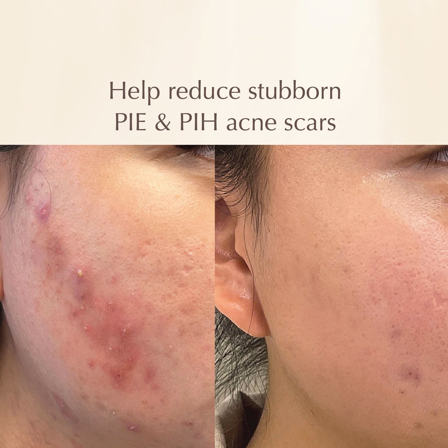 Acne Prevention Set - Fades Acne Scars with Vitamin C, Brightens Dull Skin - Deep Pore Cleansing with Gentle Exfoliation