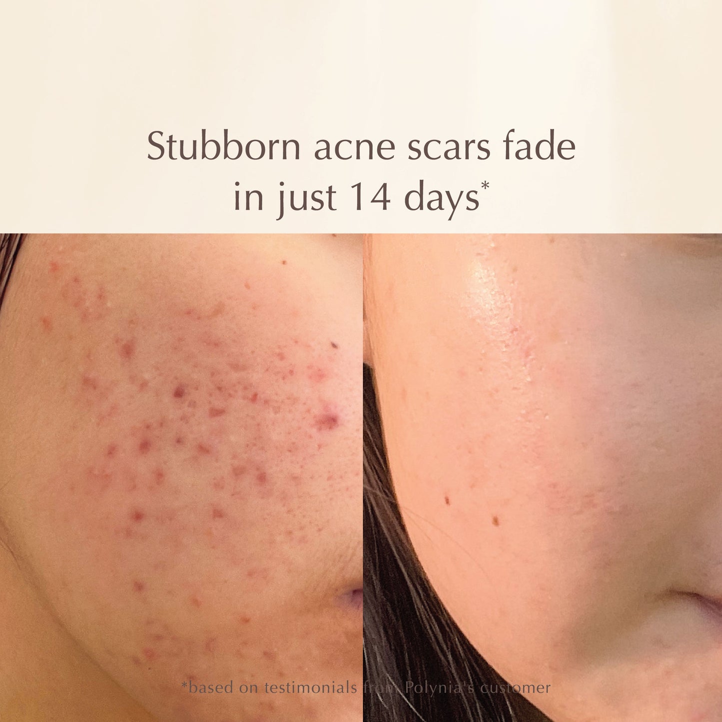Acne Prevention Set - Fades Acne Scars with Vitamin C, Brightens Dull Skin - Deep Pore Cleansing with Gentle Exfoliation