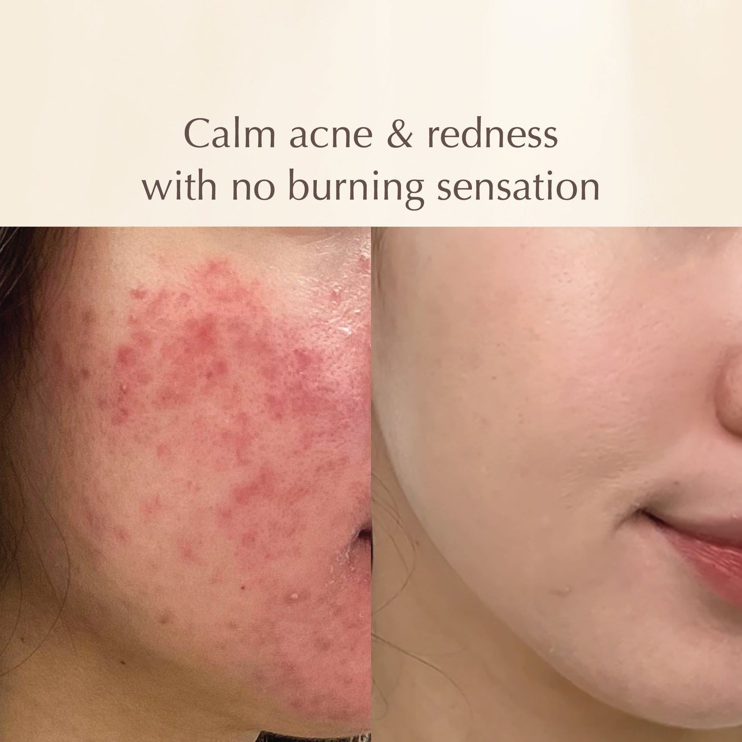Shiconix Soothing Mask – Calming Acne, Reduces Redness & Inflammation – 100ml