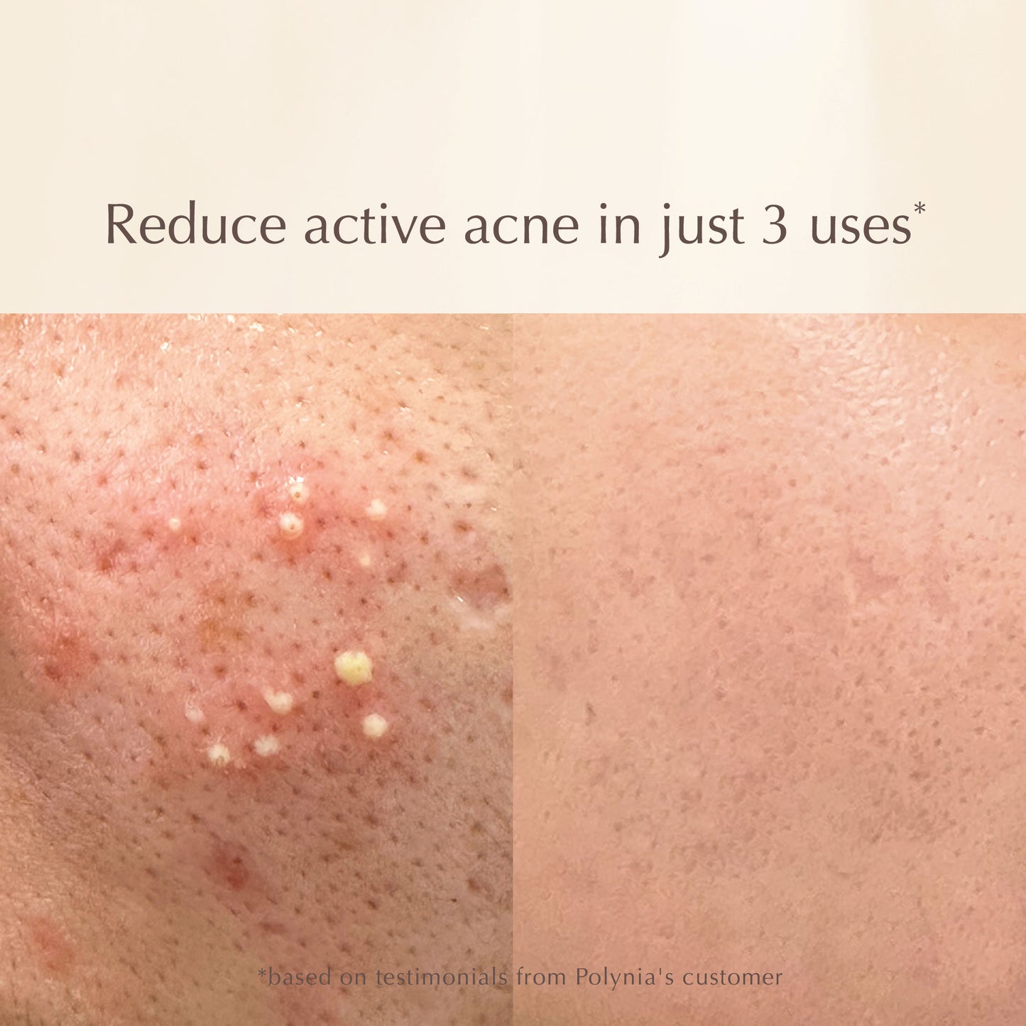 Shiconix Soothing Mask – Calming Acne, Reduces Redness & Inflammation – 100ml