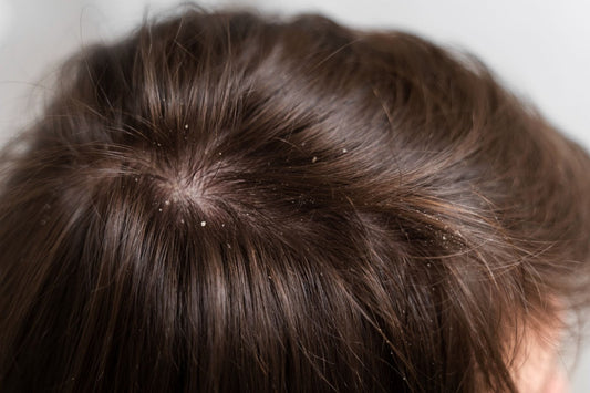 Dry Scalp? Oily Scalp? Dandruff That Never Ends? Here's What Your Scalp Is Trying to Tell You