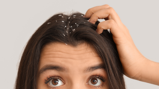 tired of dandruff? here's what really works