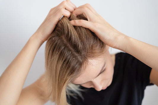 girl with dandruff and itchy hair