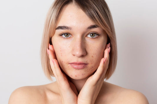 What Causes Acne? (Hint: It’s Not Just Greasy Food)
