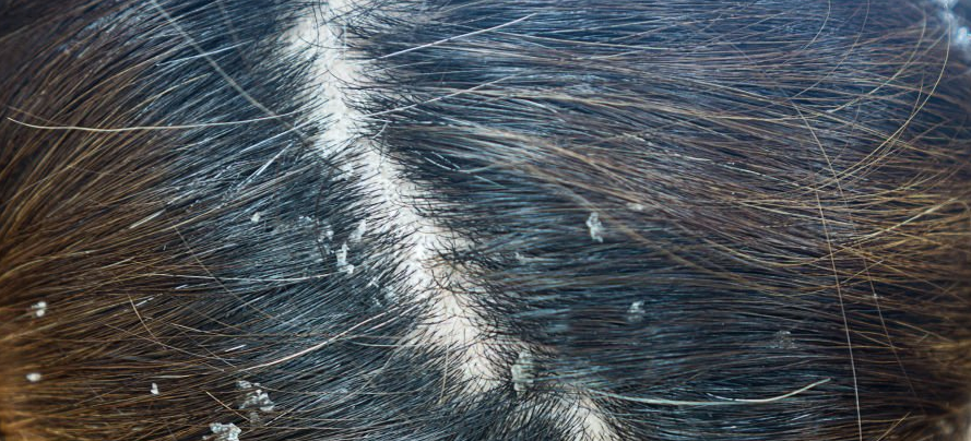 what is dandruff, really?