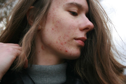 what's causing breakouts