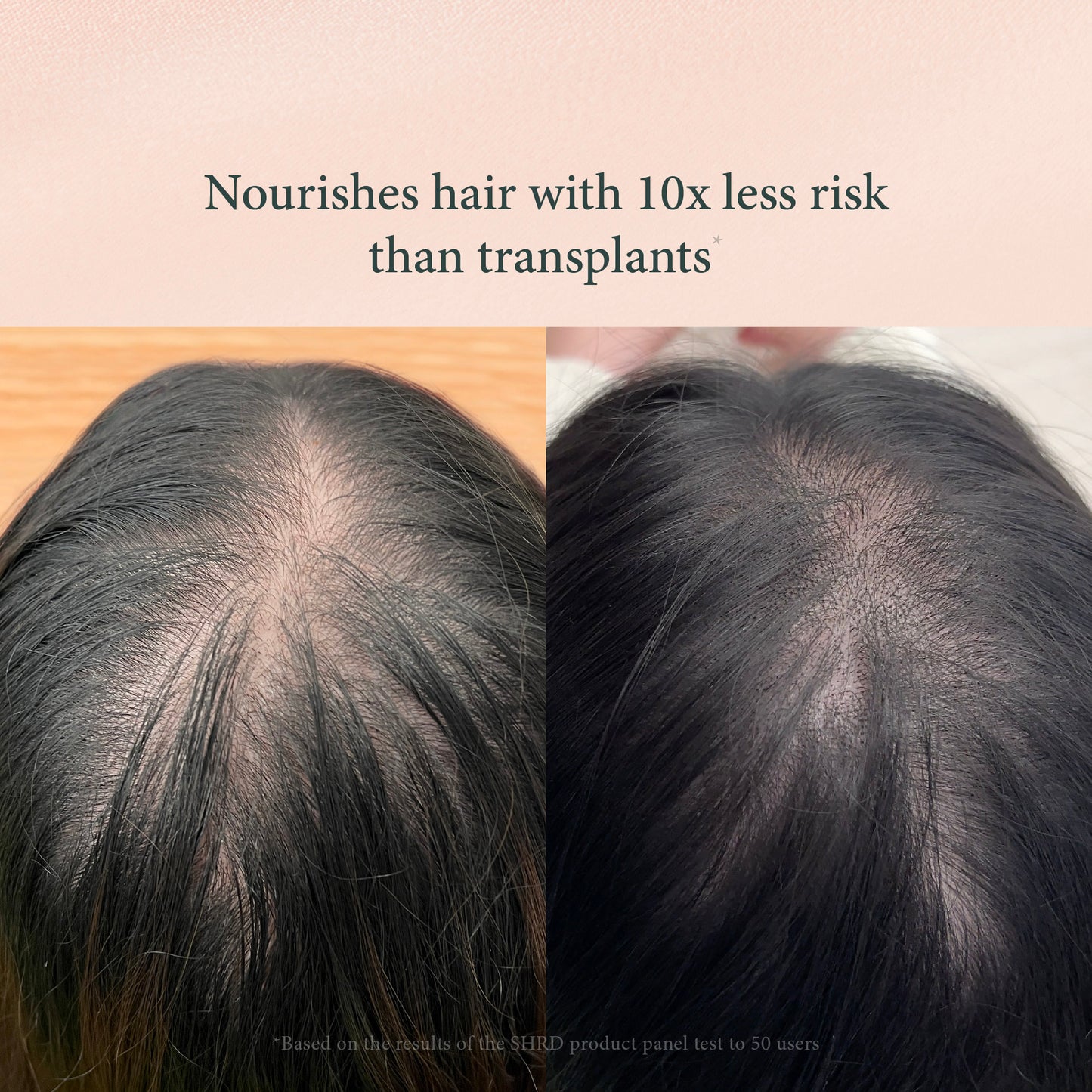 SHRD Exclusive Hairfall Treatment – Reduces Hair Fall, Strengthens Roots, Boosts Scalp Health – Safe for Daily Use on All Hair Types