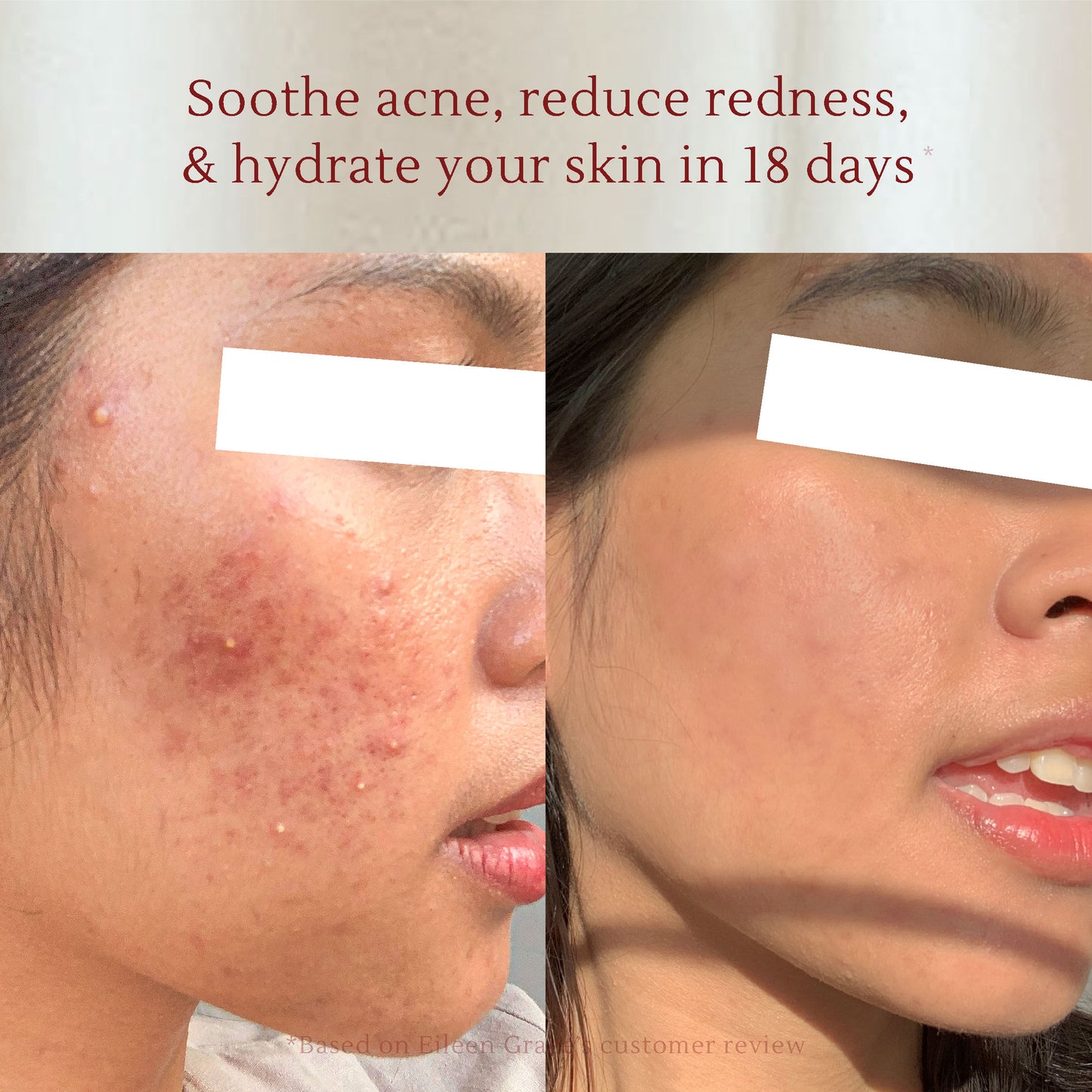 Acne Care Essence – Soothing & Hydrating Gel for Acne-Prone Skin – Prevents Acne, Reduces Redness & Increases Glowing Skin – 30ml