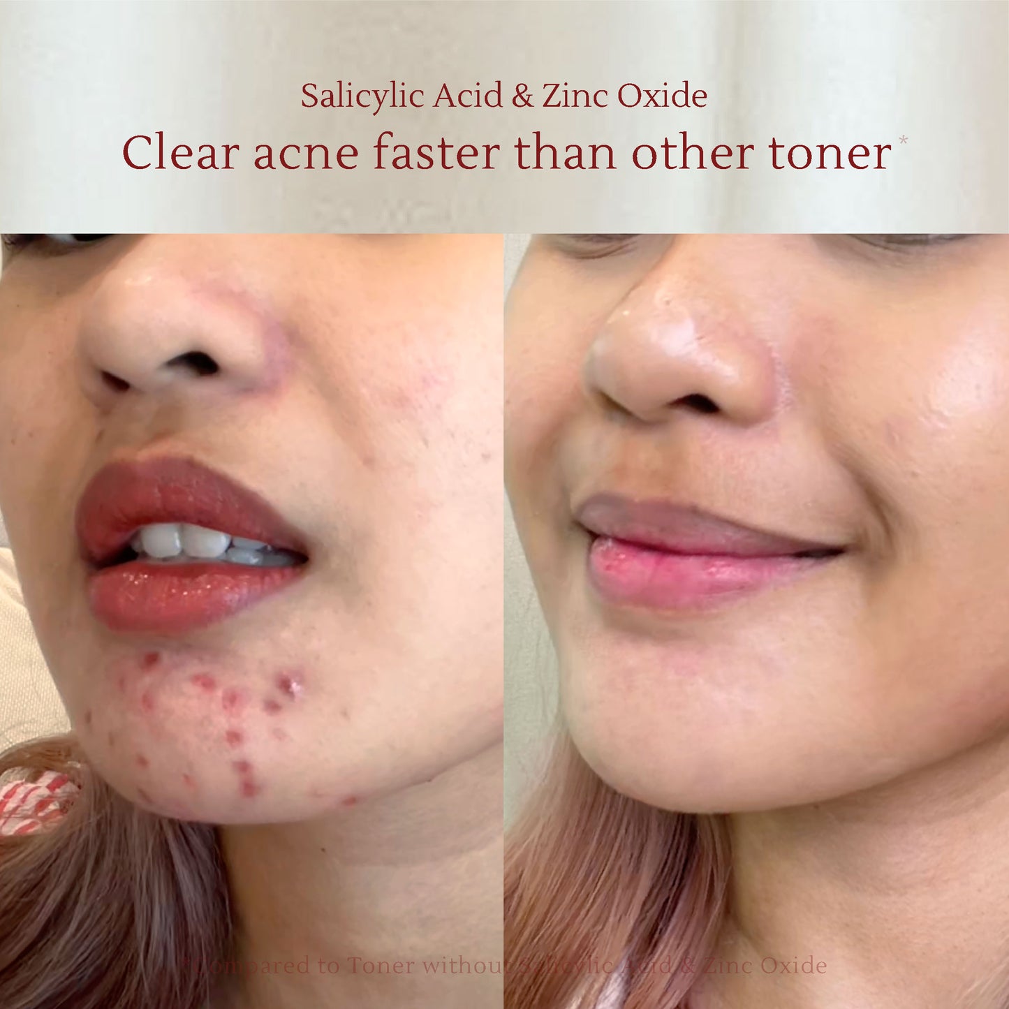 Salicylic Toner – Acne Treatment with Rose Water, Zinc Oxide & Vitamin C – Fades Acne Scars, Redness & Brightens Skin – 120ml