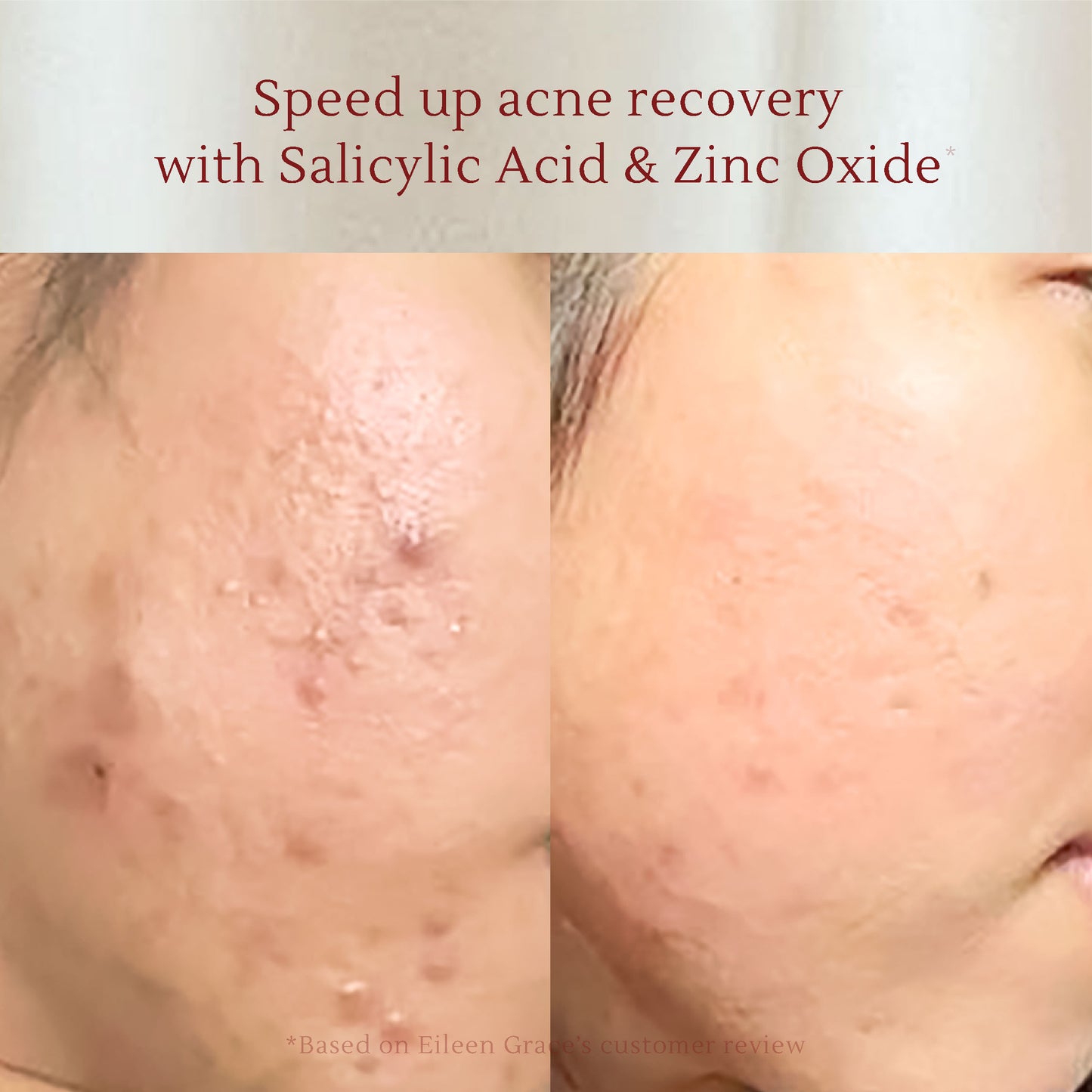 Salicylic Toner – Acne Treatment with Rose Water, Zinc Oxide & Vitamin C – Fades Acne Scars, Redness & Brightens Skin – 120ml