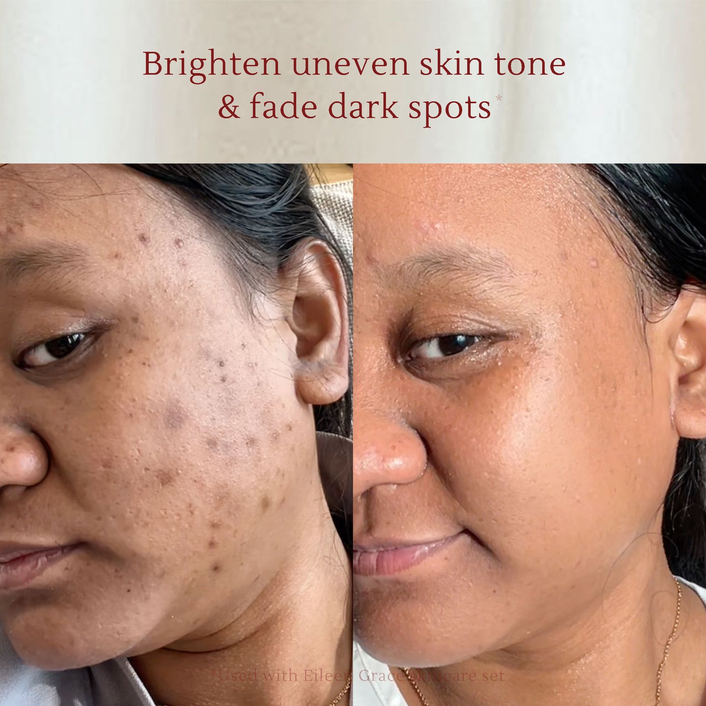 Salicylic Toner – Acne Treatment with Rose Water, Zinc Oxide & Vitamin C – Fades Acne Scars, Redness & Brightens Skin – 120ml