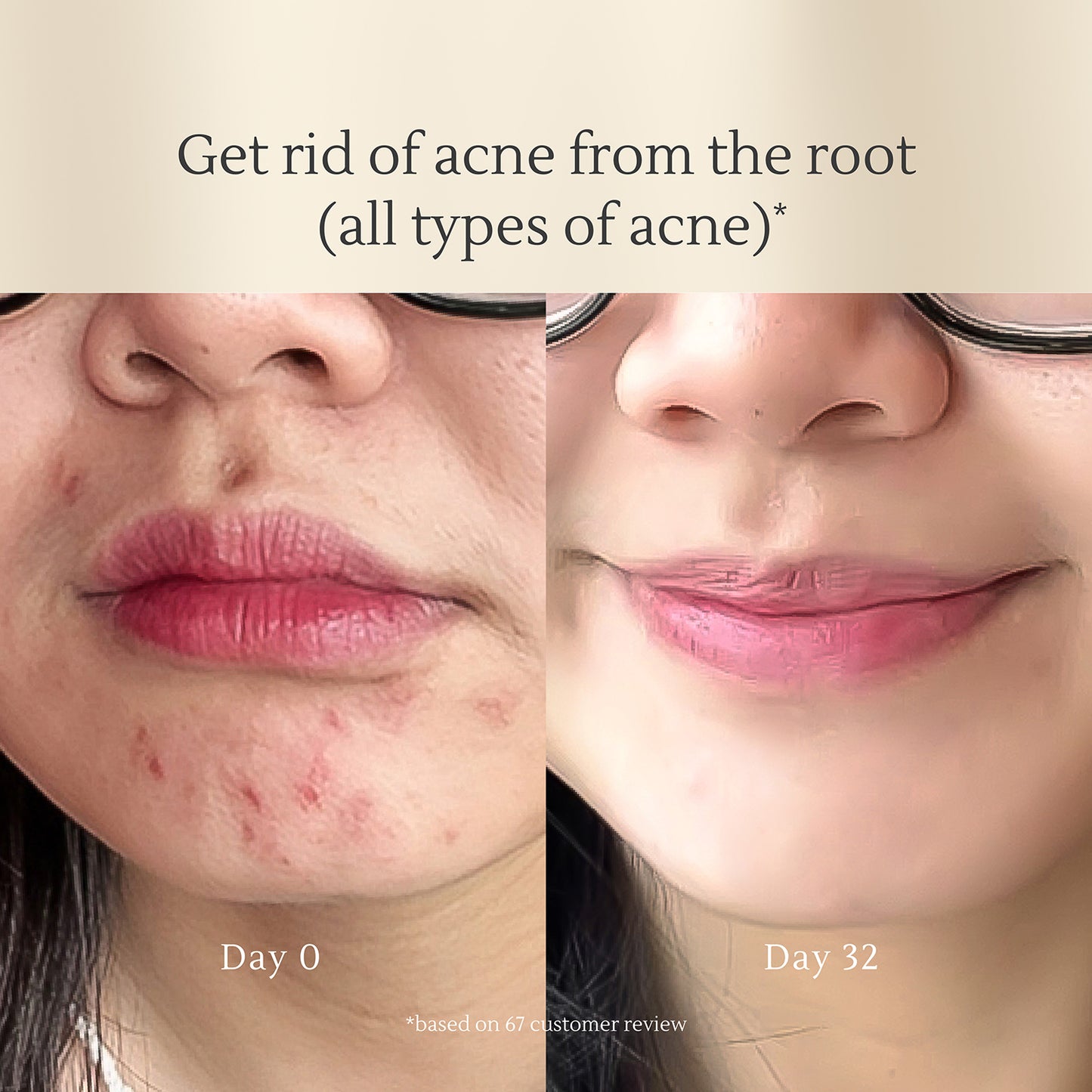 Acne Soothing Serum – Caviar Lime & Salicylic Acid for Acne, Pore Control & Scar Fading – 50ml