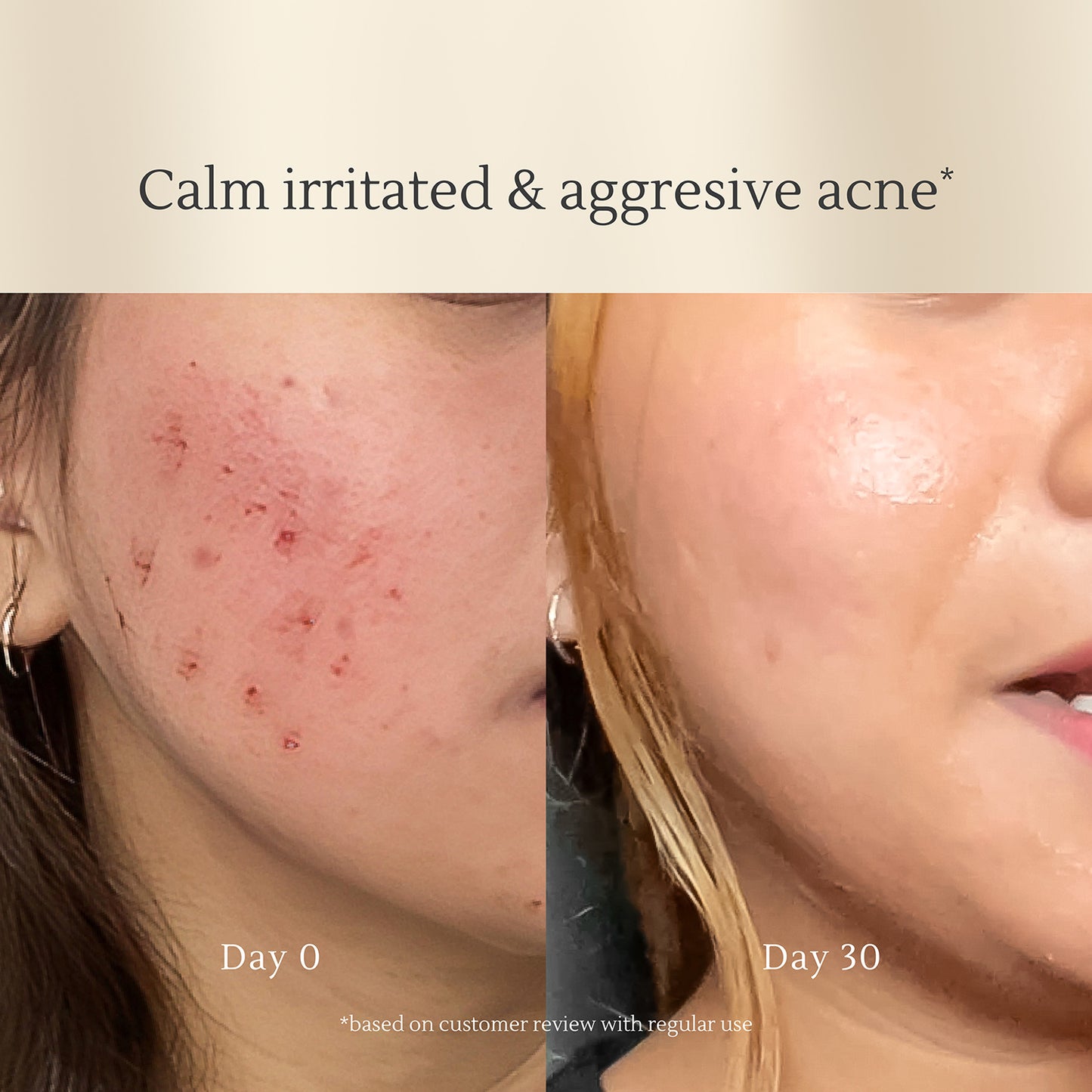 Acne Soothing Serum – Caviar Lime & Salicylic Acid for Acne, Pore Control & Scar Fading – 50ml
