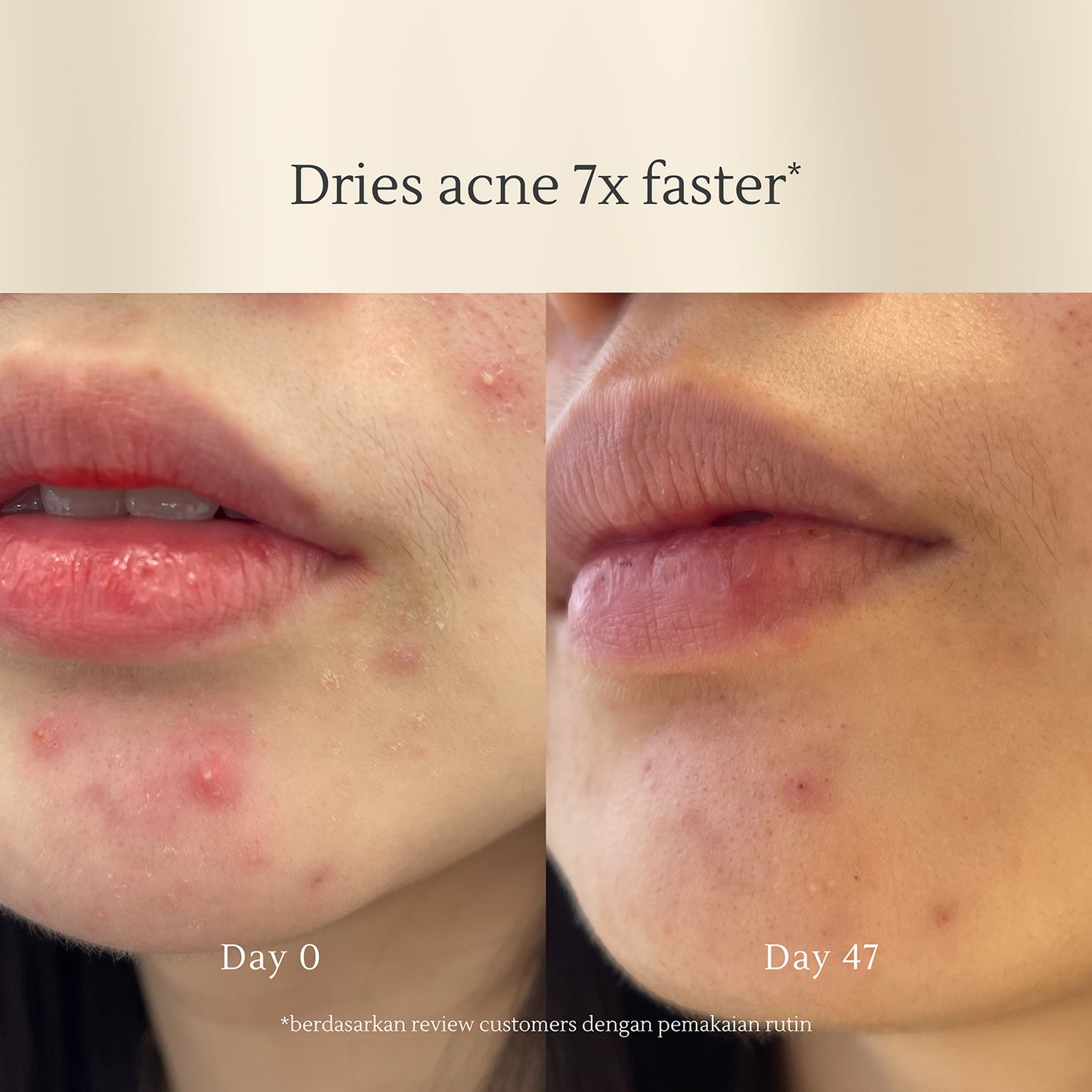 Acne Cleansing Cream – Daily Face Wash for Acne & Oily Skin – 100ml