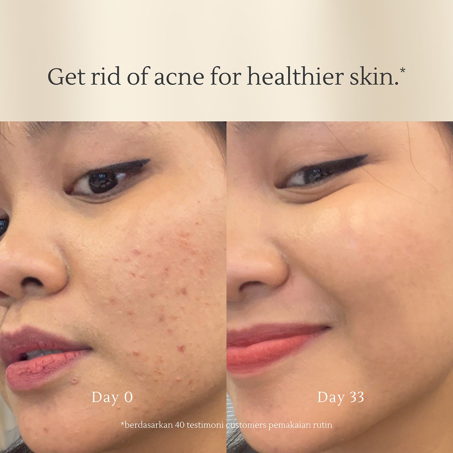 Acne Cleansing Cream – Daily Face Wash for Acne & Oily Skin – 100ml