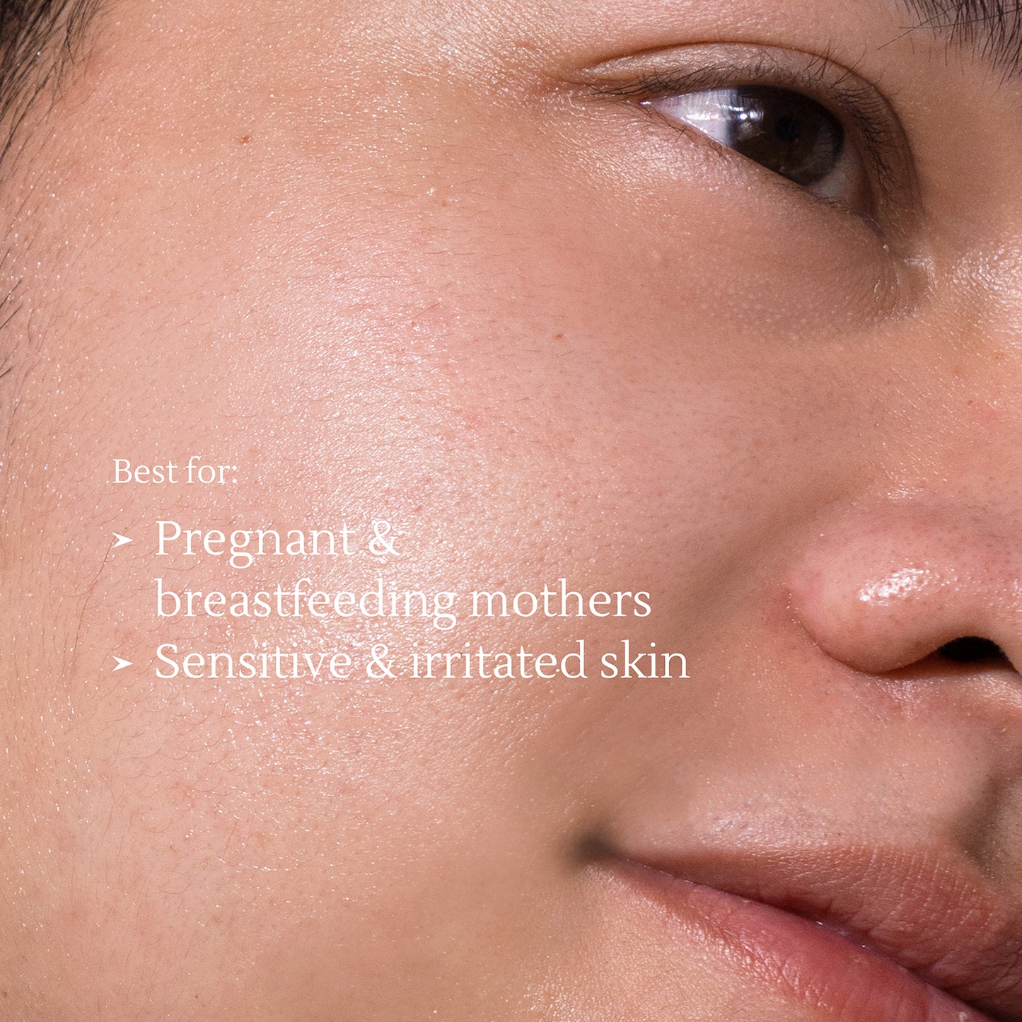 Acne Cleansing Cream – Daily Face Wash for Acne & Oily Skin – 100ml