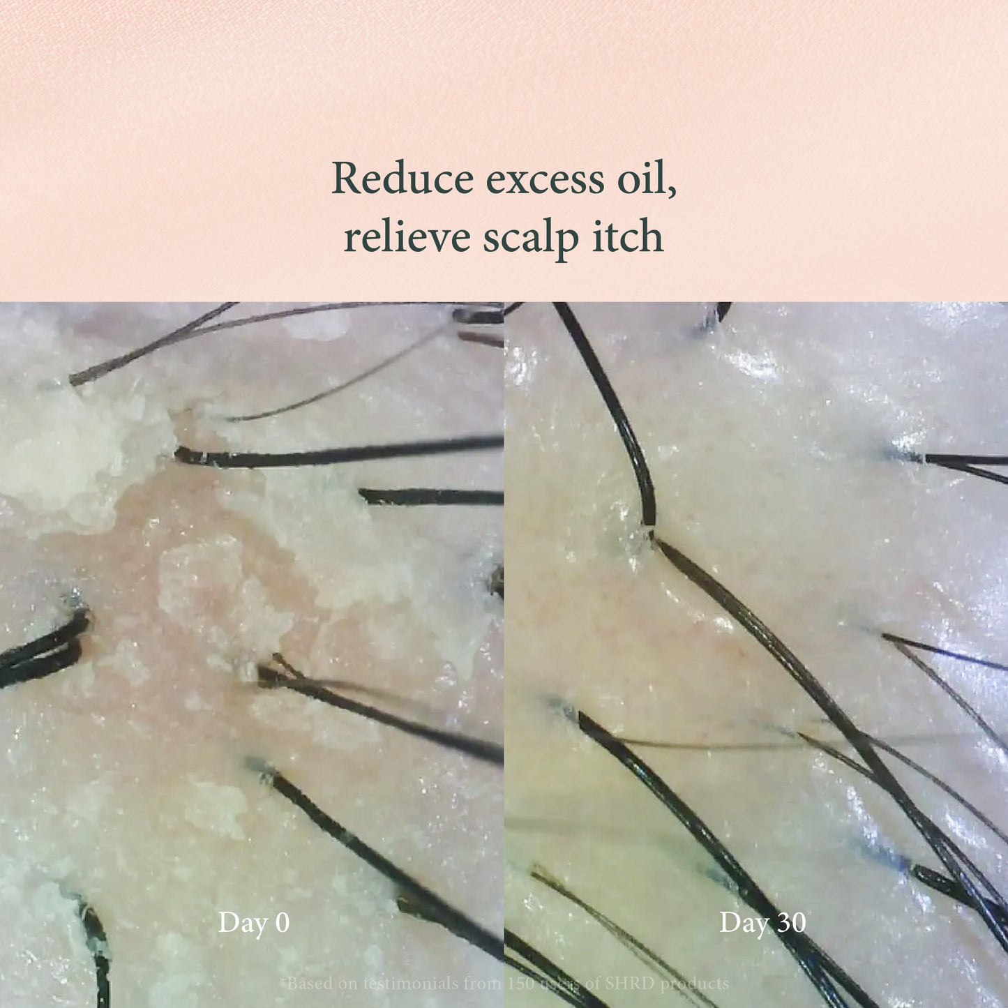 Scalp Massage Comb – Hair Growth Stimulator & Dandruff Remover